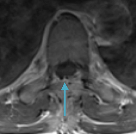 Postoperative MRI T1w demonstrating interval resection with cord re-expansion (blue arrow)