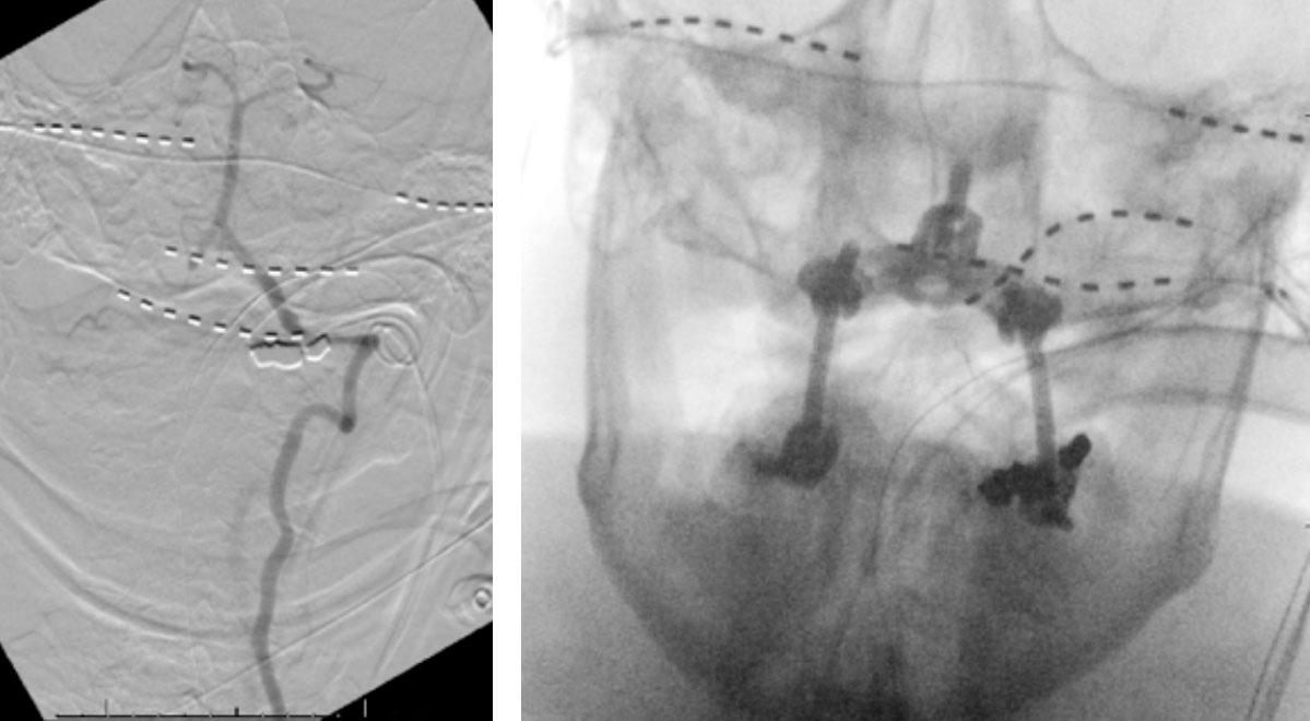Right Vertebral Artery Compression Syndrome 2