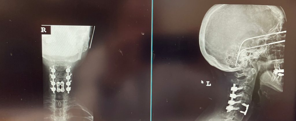 AP and Lateral cervical X-ray 6 months from surgery demonstrates a stable construct and alignment
