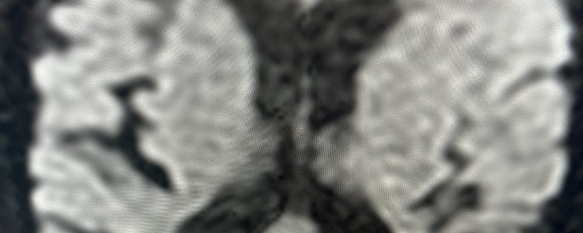 JLB Symptomatic Carotid Stenosis Fig. 1 Image scaled